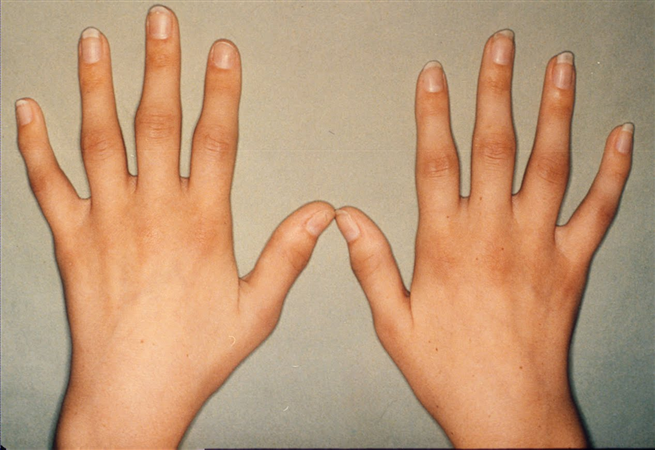 Early Clues to Rheumatoid Arthritis