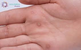 Human Papillomavirus (HPV)