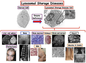 Lysosomal Storage Disorders (LSDs)