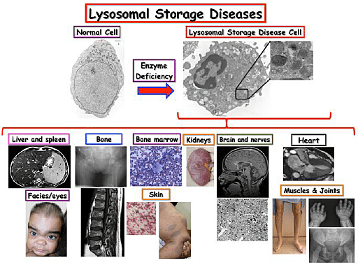 Lysosomal Storage Disorders (LSDs)