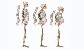 Osteoporosis: Silent Disease