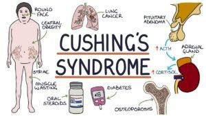 Cushing’s Syndrome (Completely Explained)