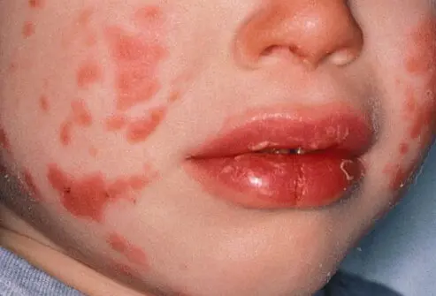 Kawasaki Disease
