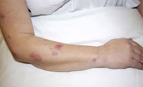 Coccidioidomycosis
