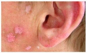 Lupus Disease