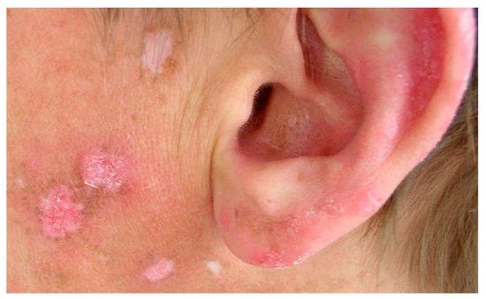 Lupus Disease