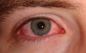 Sjogren’s Disease