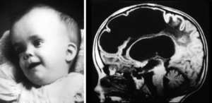 Alexander Disease