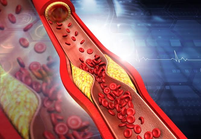 Atherosclerosis: Understanding Its Possible Autoimmune Link