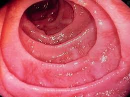 Celiac Disease