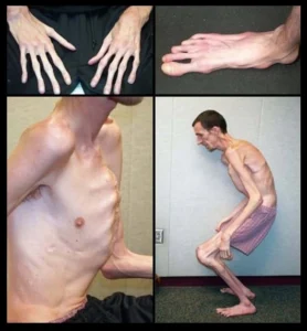 Marfan Syndrome