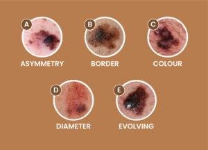 Melanoma