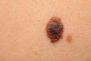 Melanoma: