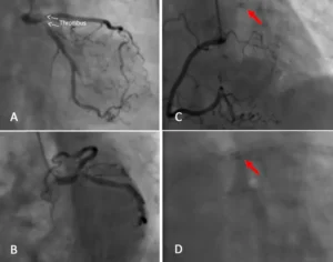Coronary Thrombosis