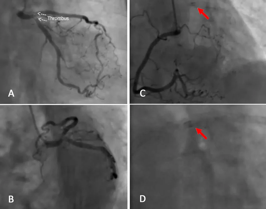 Coronary Thrombosis