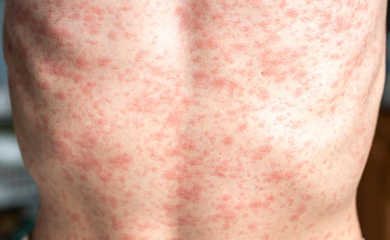 Measles