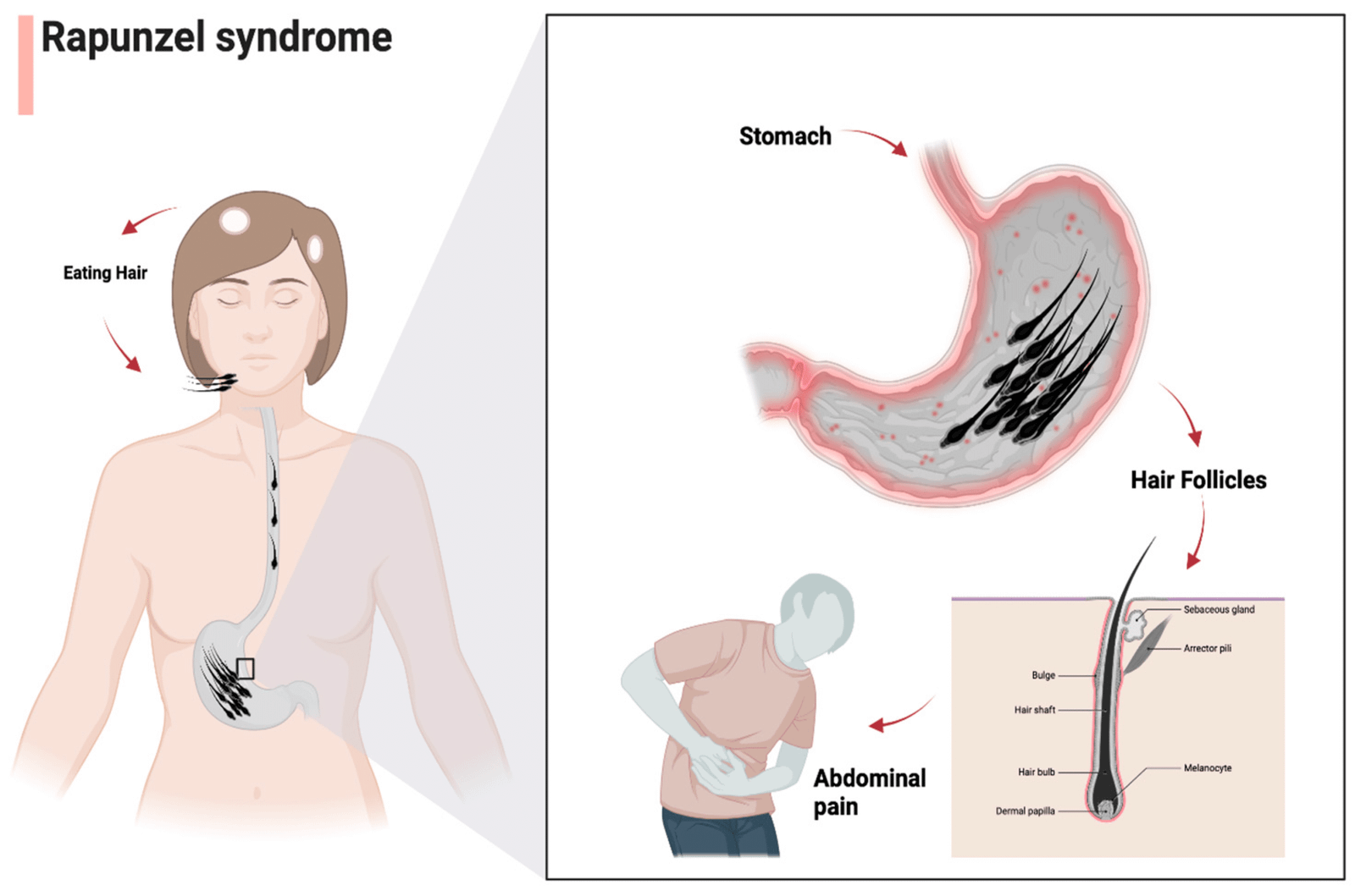 Rapunzel Syndrome: Rare Trichobezoar Disorder