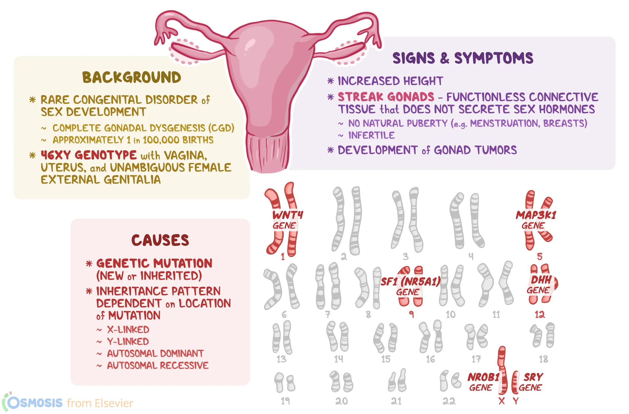 Swyer Syndrome